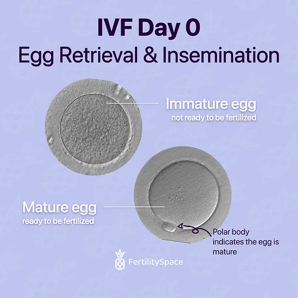 How do you know your eggs are mature? Embryologists look for the presence of a polar body which indicates that an egg is ready to be fertilized. An immature egg cannot be fertilized. Patients with low maturity on after their egg retrieval may do IVM-ICSI the next day.